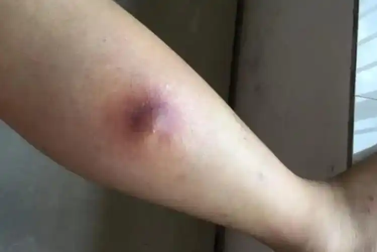 小腿有结节症状图片_图文_文章_美咯_让您放心美!