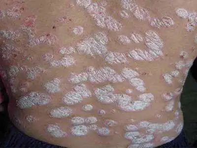 银屑病脱皮图片_银屑病求医网