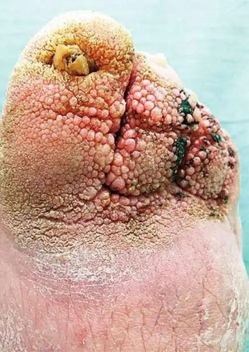 【看图识病】密集物恐惧症患者慎入!