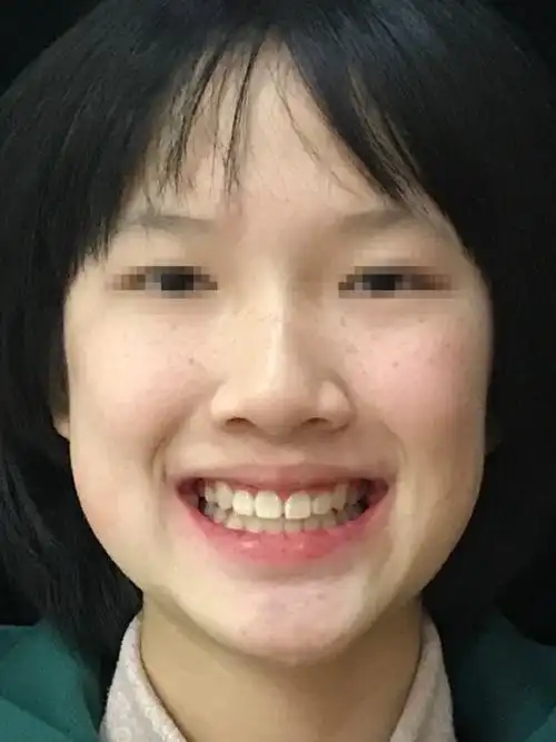 牙齿重度拥挤不齐虎牙外突严重封印了颜值