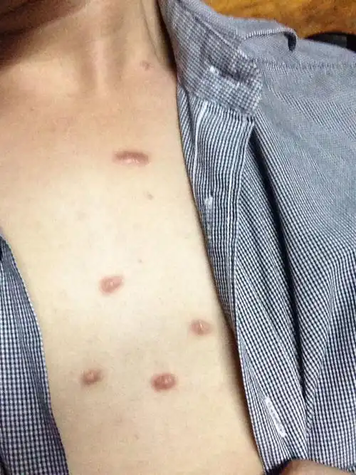 胸前有七粒这样的小肉粒,不痛不痒,几年前就有了,现在发现比之前大了