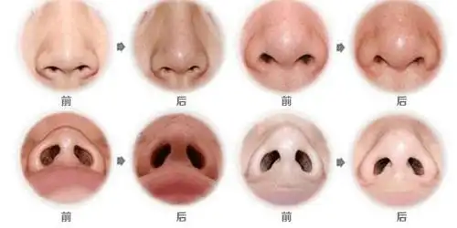 福州做鼻孔整形哪家医院效果比较好