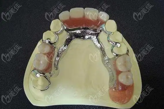 义齿的区别给大家说起,接着小编还给大家介绍下吸附式假牙的优缺点等