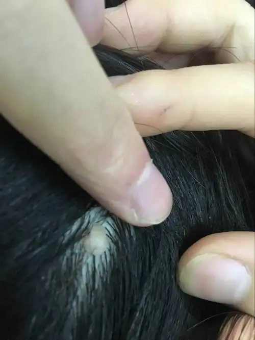 头上长了一个肉痣一样的东西,从小就有的,最近感觉变大了点,不疼不痒