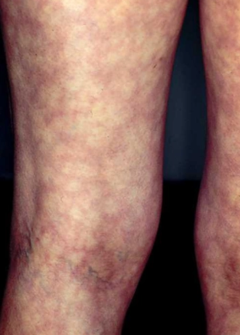 网状青斑 (37)_有来医生