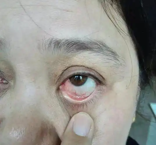 经常流泪流眼屎当心泪道阻塞泪囊炎