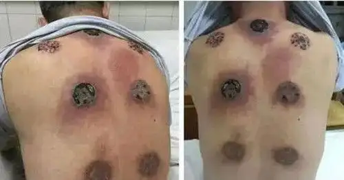 男子太累了去做拔火罐第二天一看背部的痕迹顿时崩溃不已