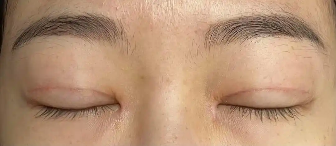 术后恢复贴内双肿泡眼严重内眦赘皮全切开内眼角930手术