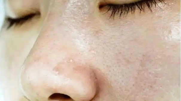 请问脸上痘坑特别多,毛孔粗大,有啥好办法吗?