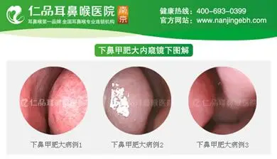 鼻甲肥大的危害有哪些