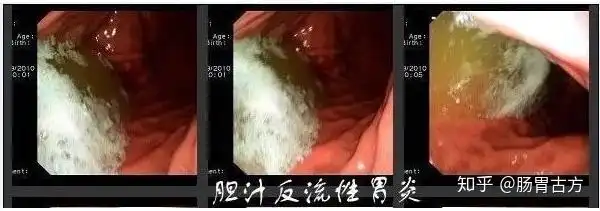 胆汁反流是怎么造成胃粘膜损伤的呢?看完你就会明白!