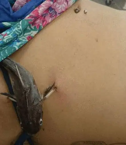 女子游泳时腹部突然疼痛上岸后掀开衣物一瞧悲剧了