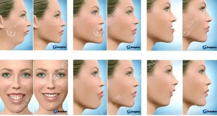 骨性凸嘴下巴后缩没有下颚线,做正畸正颌联合治疗能改善吗-儿牙-妈妈