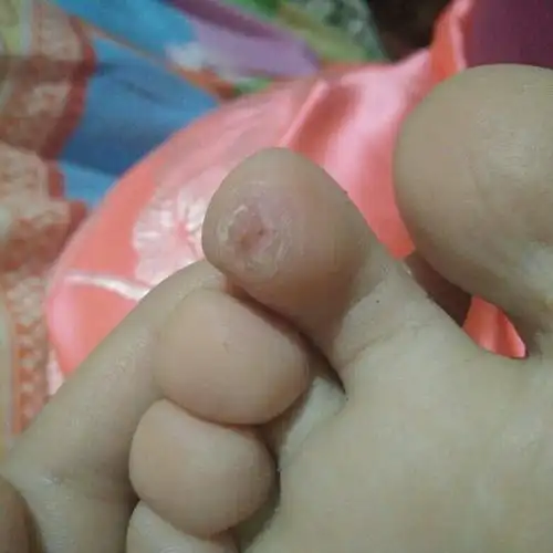 跖疣 偶然一次发现我脚底下长了个类似于水泡的东西,就没在意,后来