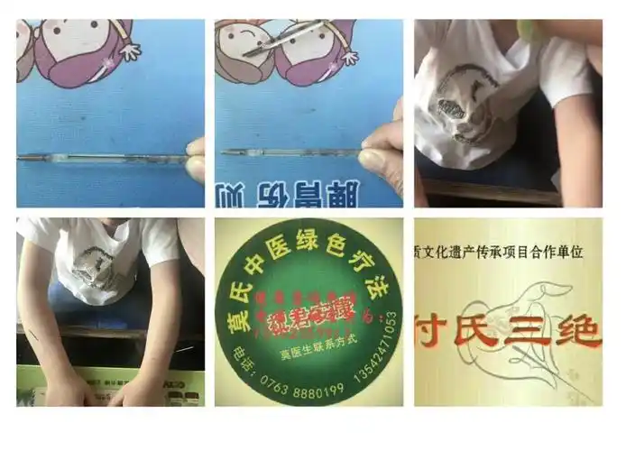 付氏三绝针治疗发热儿童患者的临床疗效