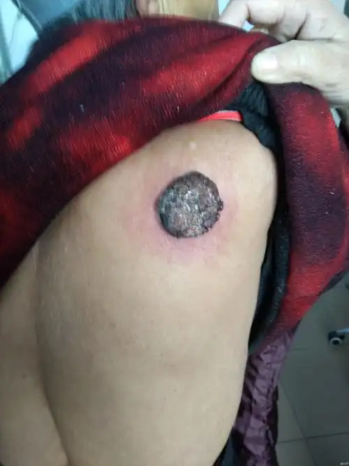 老太太右侧肩背部的大瘊子