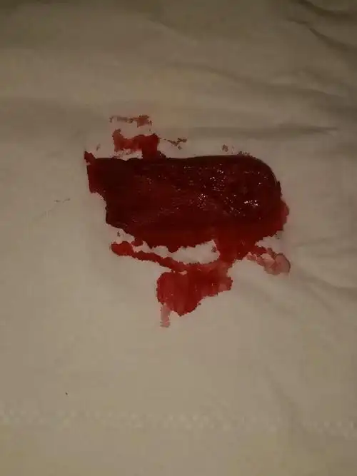 第一次流鼻血,流的最多(最大)的一次