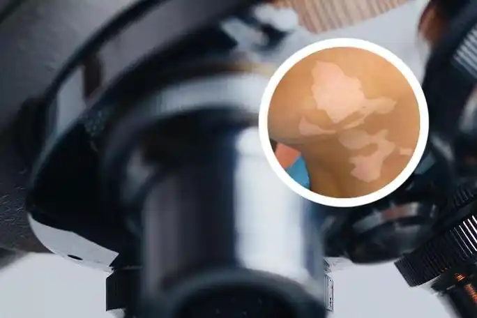 小儿汗斑和白斑图片对比_求医网