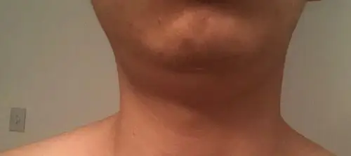 下颚两侧淋巴结明显大,下垂下来,已经有三五年了,去看过医生也拍过