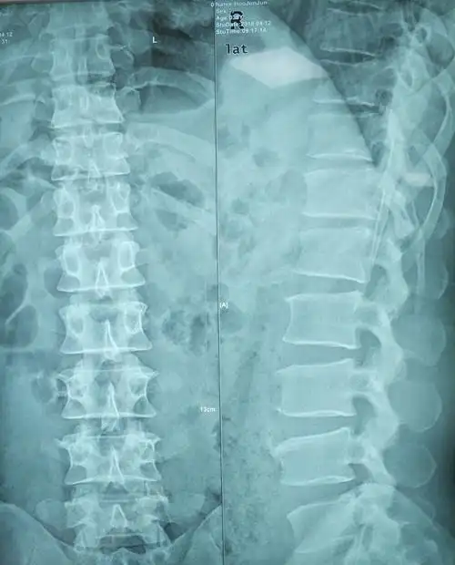 【病例快讯】经皮脊柱内镜技术治疗胸腰段椎间盘突出症(t12-l1)