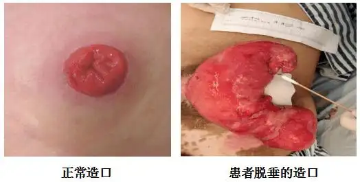 造口脱垂十分严重让医护人员大吃一惊这次入院检查结果多年来患者对