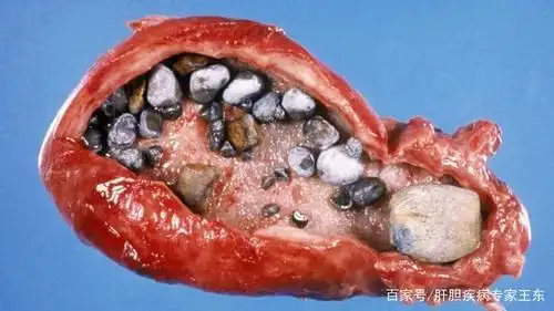 胆囊癌总是静悄悄的来,专家提醒:它才是"隐形杀手"!别忽视了