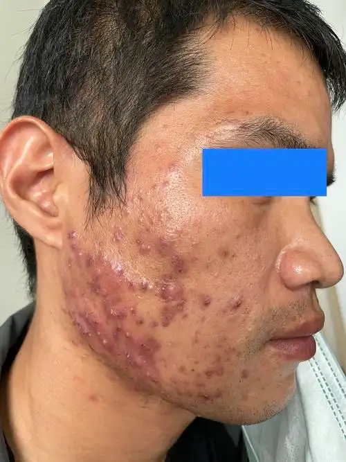 看图识病:痤疮(重度) - 好大夫在线