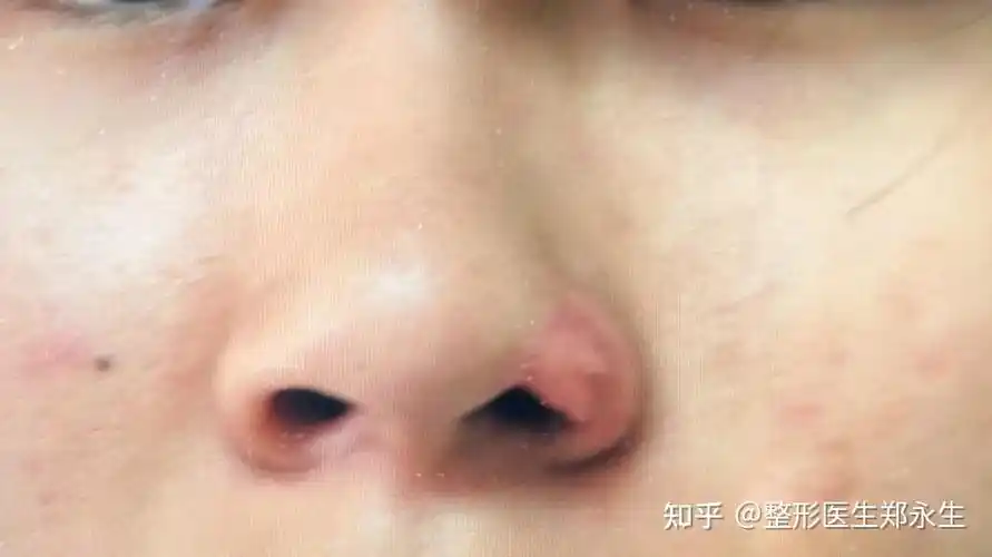被狗咬造成鼻翼缺失还能修复吗? - 知乎