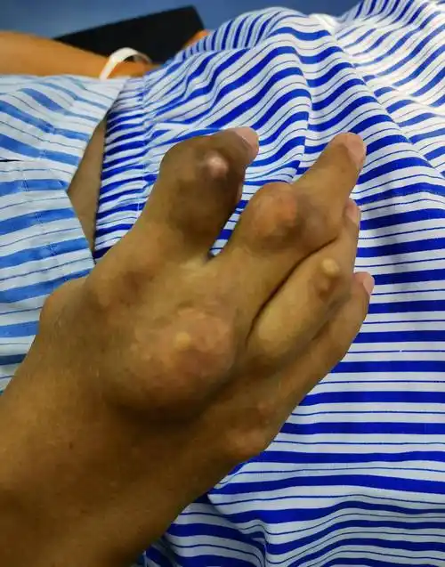 高尿酸血症致全身多处巨大痛风石形成,取出术成了骨科医生的噩梦_关节