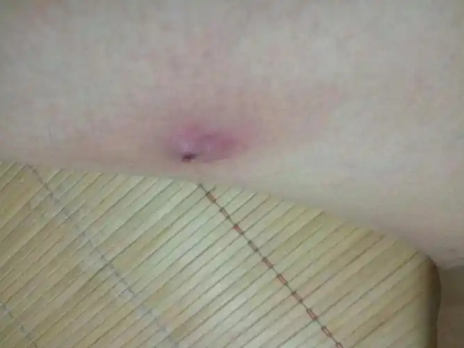 腿上肿了个包谁知道这是什么情况有图片