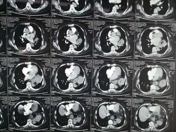 食管裂孔疝的腔镜治疗