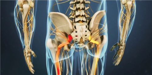 坐骨神经痛屁股肿了怎么办