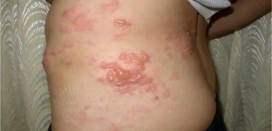 生孩子般的痛!为治好"缠腰龙",有人放了5次血