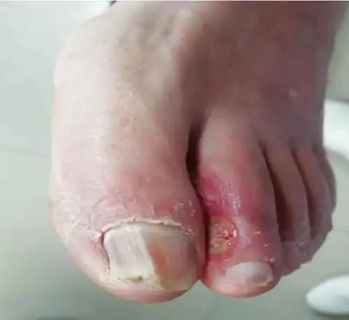 糖尿病8年,75岁高龄合并多种并发症,怎么治?