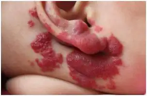 新冠疫情下被耽误治疗的婴幼儿血管瘤_婴幼儿血管瘤_介绍_治疗方式 -