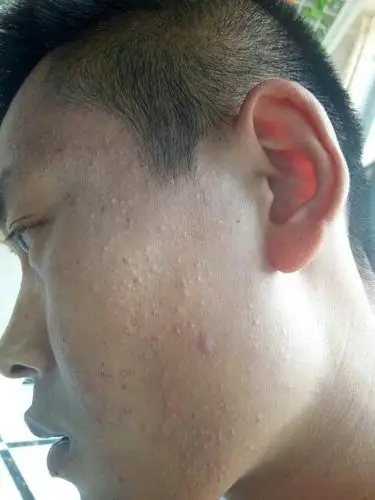 脸上都是很小的小疙瘩,密密麻麻的,这是什么啊