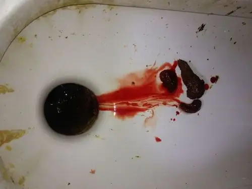 大便出血肛门出血图片可能有点恶心希望能懂的人说下_百度知道