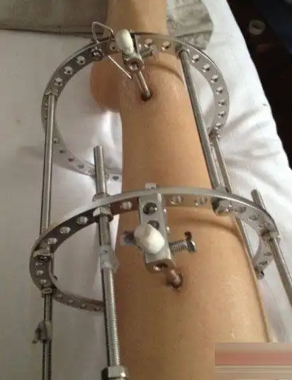 矫正"o型腿"手术全过程(组图)