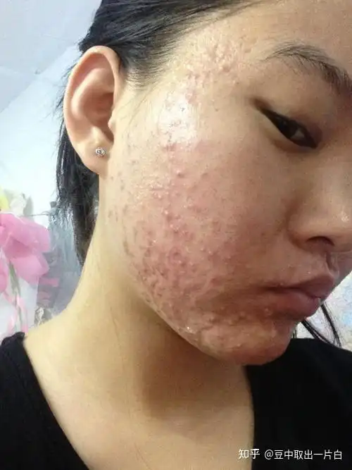丘疹,炎症性痘痘去医院治疗好还是去祛痘机构好呢? - 知乎
