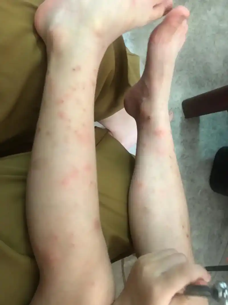 腿不是一般的腿 一到夏天这皮肤就折磨死人,蚊子虫子咬到就抓 - 兑趑