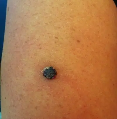 容易癌变的黑痣图片57