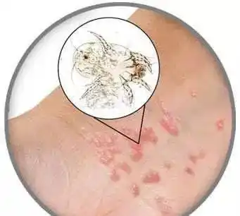 比较常见的部位像手指缝,手腕,包括下腹部,外阴部位,还有大腿根的内侧