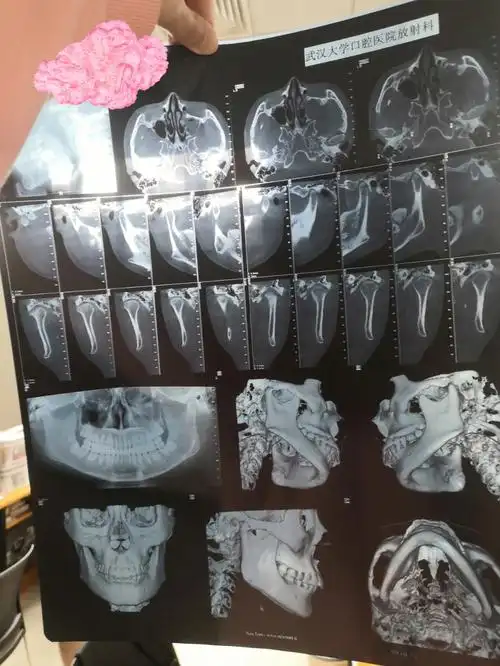 武大口腔丨颞下颌关节紊乱97