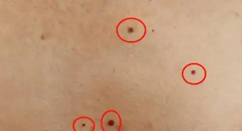 胸前长了几个红痣是不是肝脏有问题了