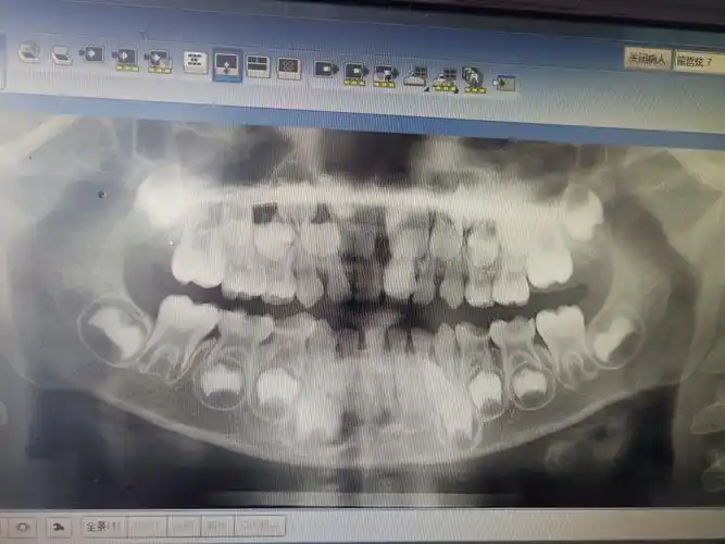 孩子今年7岁,这是在诊所拍的片子,哪位内行人能帮
