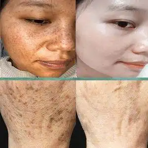 氢醌霜软膏官网正品乳膏氨甲环酸去祛斑黄褐斑分解黑色素沉千着白