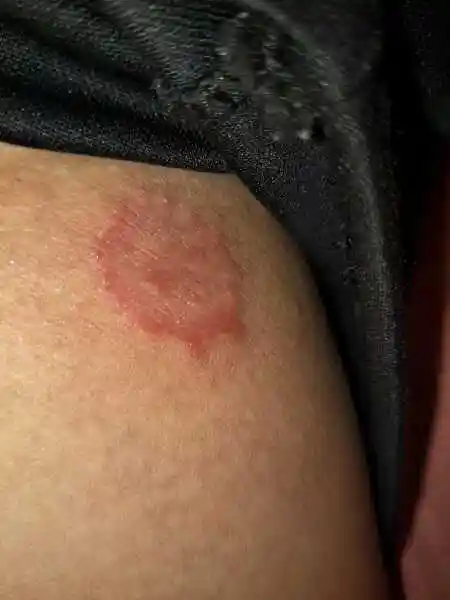 这是什么皮肤病 1条回答  癣.