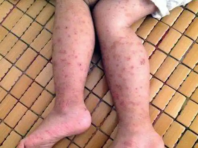 青州神经性皮炎治疗——皮肤病治疗哪家专业