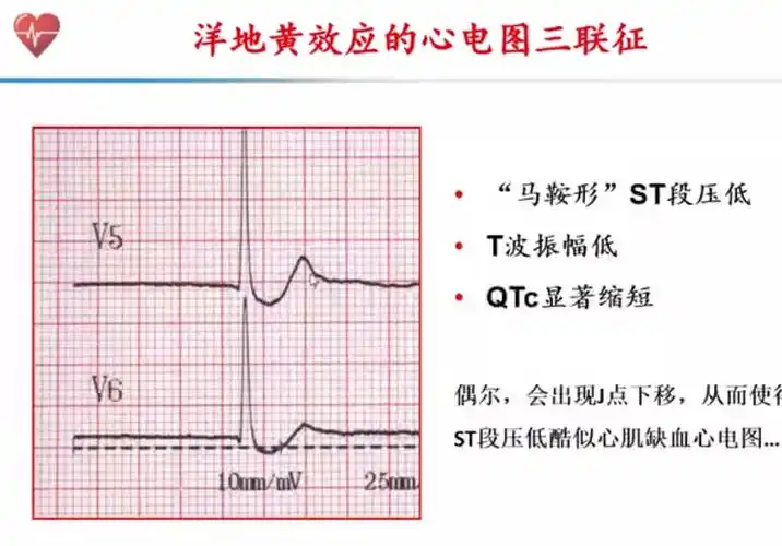 起效or中毒洋地黄制剂应用的结局只在一线之间