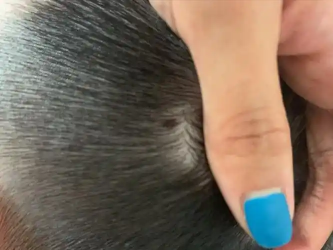 孩子出生时头皮有一颗痣现在4岁半痣越来越大我想请您看下